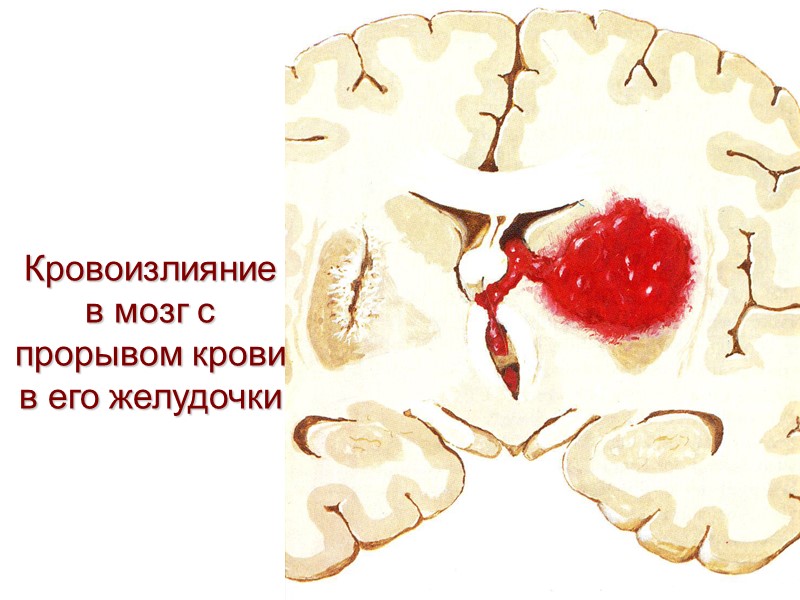 Кровоизлияние в мозг с прорывом крови в его желудочки
